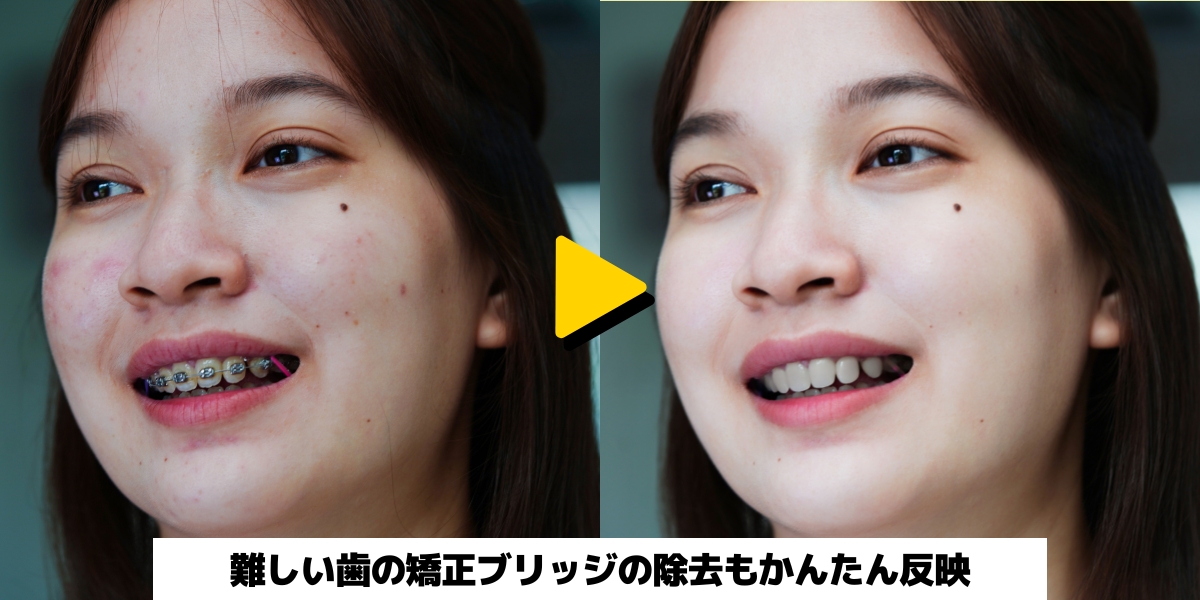 強制ブリッジ補正：難しい歯の矯正ブリッジの除去もかんたん反映